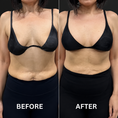 Restore Your Natural Lift & Confidence – No Surgery Required